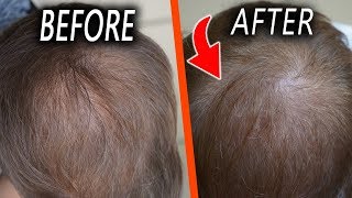 Topical Finasteride  1 month Update Only one side effect [upl. by Oicaroh191]