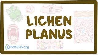 Lichen planus  causes symptoms diagnosis treatment pathology [upl. by Eiveneg]