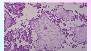 GESTATIONAL TROPHOBLASTIC DISEASE Copy [upl. by Grani]