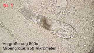 Demodex Milben [upl. by Attennot]