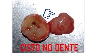 😱CISTO  BOLHA NO DENTE  Pode acabar com dentes e ossos [upl. by Nhoj]