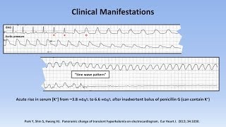 Hyperkalemia [upl. by Solahcin]