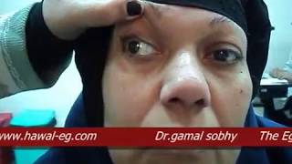 Third Nerve Palsy  شلل العصب الثالث [upl. by Auqemahs]