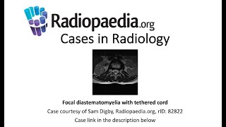 Focal diastematomyelia with tethered cord Radiopaediaorg Cases in Radiology [upl. by Eneroc]