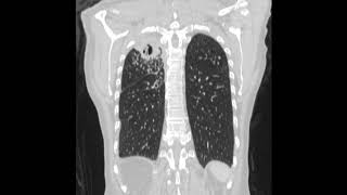 Chronic pulmonary aspergillosis after pulmonary tuberculosis [upl. by Mehcanem728]