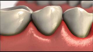 Understanding Gum Disease From Colgate [upl. by Juetta]