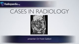 Cases in Radiology Episode 2 abdomen CT [upl. by Ailicec241]