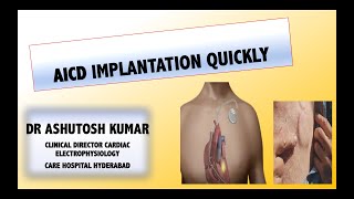 Automatic Implantable Cardioverter Defibrillator AICD ImplantationHow it is implanted [upl. by Buckie333]