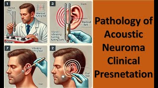 3 Pathology of Acoustic Neuroma Clinical Presnetation [upl. by Chin]