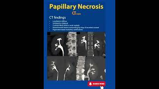 Papillary Necrosis  CT  Radiology [upl. by Noah]