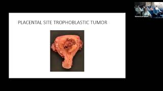 GESTATIONAL TROPHOBLASTIC DISEASE  Lecture by Prof Farrukh Zaman [upl. by Yelnats]