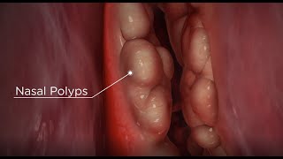 Nasal Polyps diagnosis and treatment options [upl. by Jadwiga]