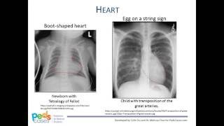 Approach to Pediatric Chest XRays [upl. by Simons]