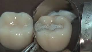 Class II Amalgam Preparation amp Restoration  Operative Dentistry [upl. by Hterrag]