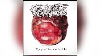 Hyperkeratotic  Seboherric Keratotsis 2023 GOREGRIND [upl. by Etnoled585]