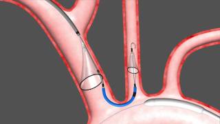 Animation of Sentinel™ Cerebral Protection System [upl. by Kutzer]