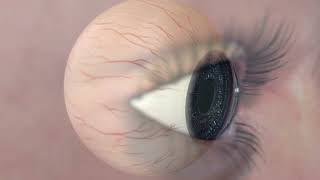 Animation Diabetic Retinopathy [upl. by Enimajneb]