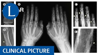 Hyperparathyroidism shows its hand findings of osteitis fibrosa cystica [upl. by Aimehs]