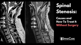 Spinal Stenosis Causes and How to Treat It Without Surgery [upl. by Mccall]