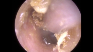 178 Removal of Ear Wax reveals Signs of Otomycosis  Mr Neel Raithatha The Hear Clinic [upl. by Sane436]