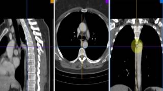 Radiologia Para Estudiantes TC de mediastino [upl. by Erroll384]