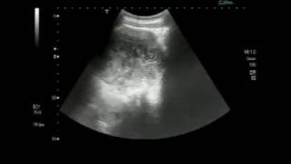 Ultrasound video of Worms  Ascaris lumbricoides  Roundworm  in the Gall Bladder [upl. by Nereus]