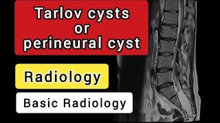 Tarlov cystsperineural cysts  Radiology [upl. by Yttiy]