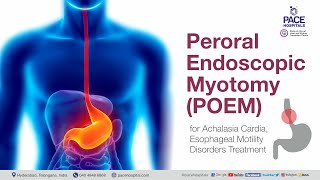 POEM Surgery Peroral Endoscopic Myotomy  POEM Procedure for Achalasia Cardia Treatment [upl. by Leissam]