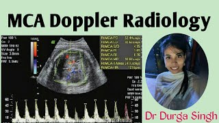 MCA Doppler radiology [upl. by Deb228]