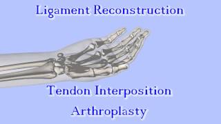 The Anchovy Procedure for Thumb Basal Joint Arthritis [upl. by Madoc]