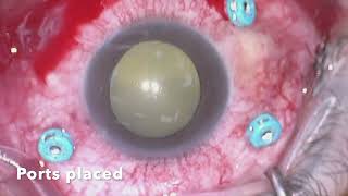 Endophthalmitis Vitrectomy [upl. by Llerrah]