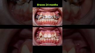 Braces correct all cases of crooked teeth braces orthodontist bracket [upl. by Hacissej]