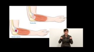 Tendinitis en Músicos ¿Cómo prevenirla [upl. by Odrude]