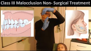 Correcting Class III Malocclusion without Tooth Extraction or Oral Surgery by Prof John Mew [upl. by Nerag]