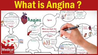 Pharmacology CVS 16 What is Angina Pectoris  Types of Angina Symptoms Causes and Treatment [upl. by Zulema149]