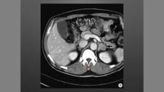 Suprarrenales Incidentaloma [upl. by Yretsym]