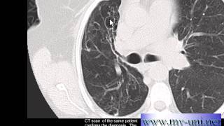 Chest xray Bronchiectasis on CT and Chest xray [upl. by Padegs]