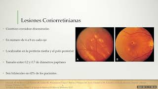 Histoplasmosis Ocular [upl. by Rego460]