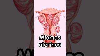 ¡Alerta Síntomas de Miomas uterinos  Dr William Guerrero medicina shorts [upl. by Bandur839]