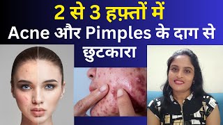 PIMPLES दाग को बोलो Goodbye  Its time to get CLEAR amp SPOTLESS SKIN [upl. by Htiduj]