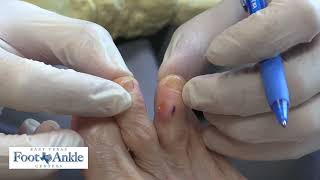 How to use a slippo pad for a hammertoe [upl. by Aner349]