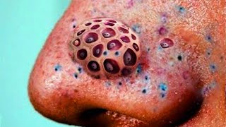 Blackheads Blackhead Removal and Trypophobia Disease [upl. by Cirederf851]