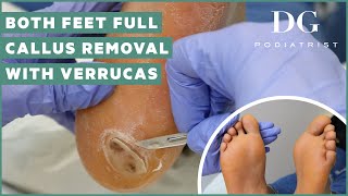 Callus removal from feet both feet and three verruca plantar warts treatment [upl. by Suraved582]