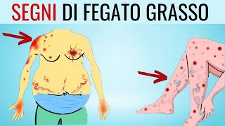 MINACCIA SILENZIOSA 8 SEGNI che POSSONO indicare una malattia del FEGATO GRASSO [upl. by Anelle]