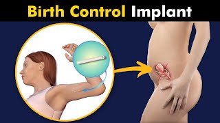 Birth control Progestin Implant  Contraceptive implant [upl. by Reivaj]