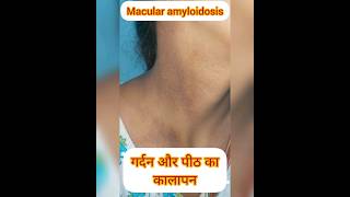 MACULAR AMYLOIDOSIS गर्दन और पीठ का कालापन pigmentation hyperpigmentation darkneck shortsfeed [upl. by Samara]