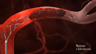 Ictus Ischemico la trombectomia meccanica novità di trattamento [upl. by Ahsei530]