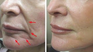 Just 2 skin tightening and face lifting home remedies [upl. by Sutit]