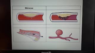 1ST2S Vidéo 5 lathérosclérose [upl. by Notned]