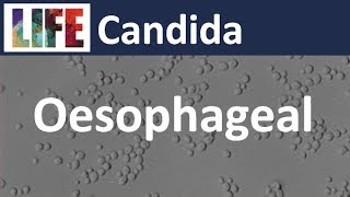 Oesophageal Candida [upl. by Mortensen344]